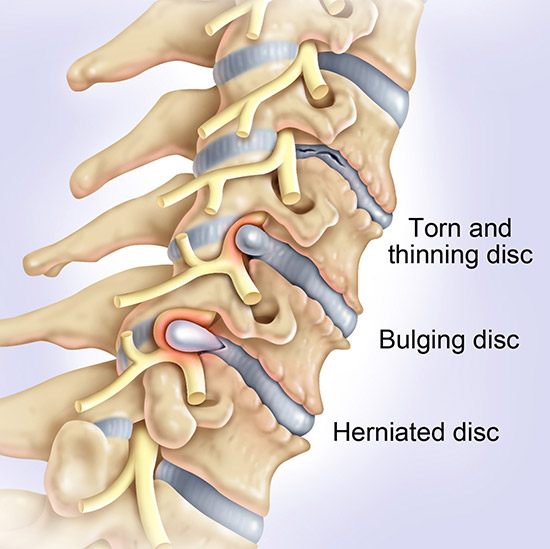Cervical Disc Replacement